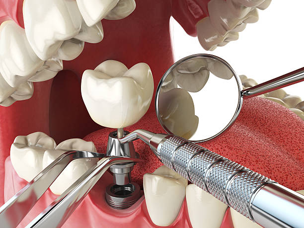 Best Emergency Treatment for Dental Infections or Abscesses in Waterford, WI